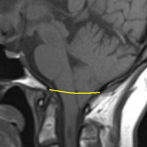 Chiari 1.5 Malformations, Explained