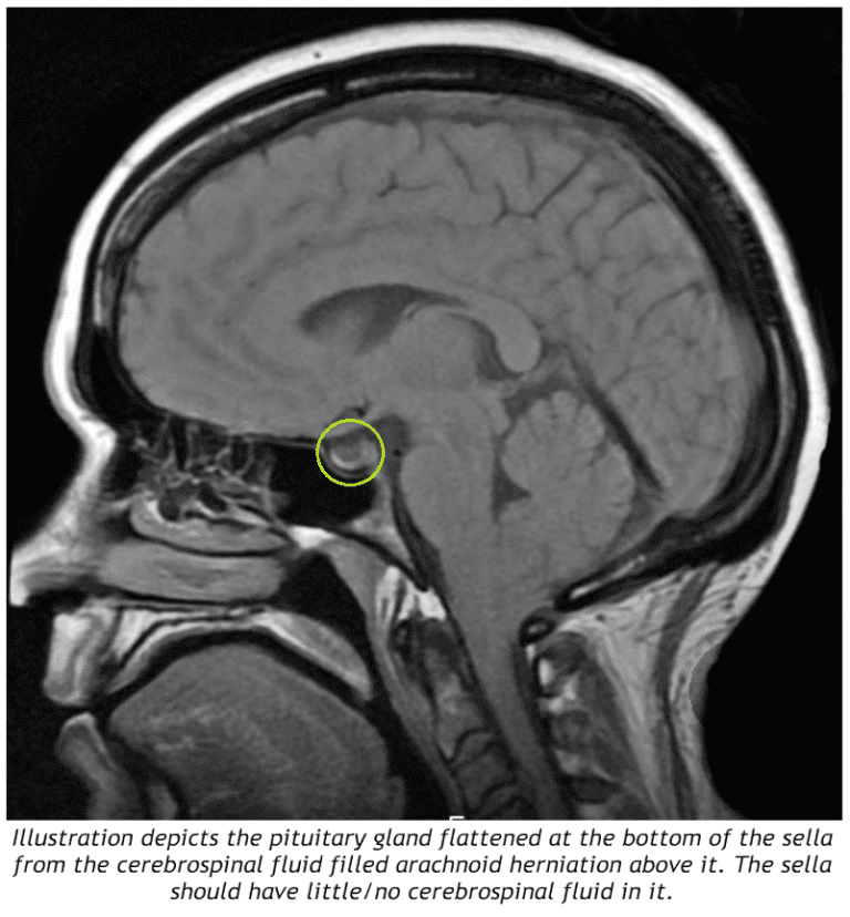 empty-sella-syndrome-archives-chiari-bridges