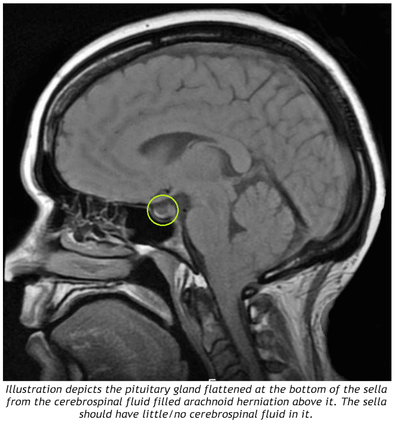 Empty Sella Mri