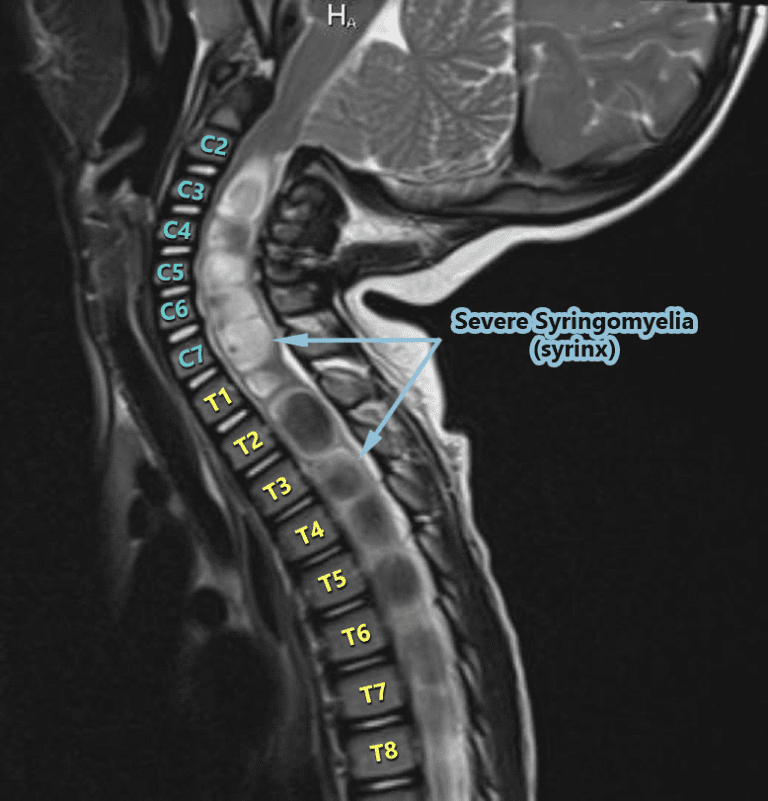 From The Inside Out - Understanding Syringomyelia & Syringobulbia ...