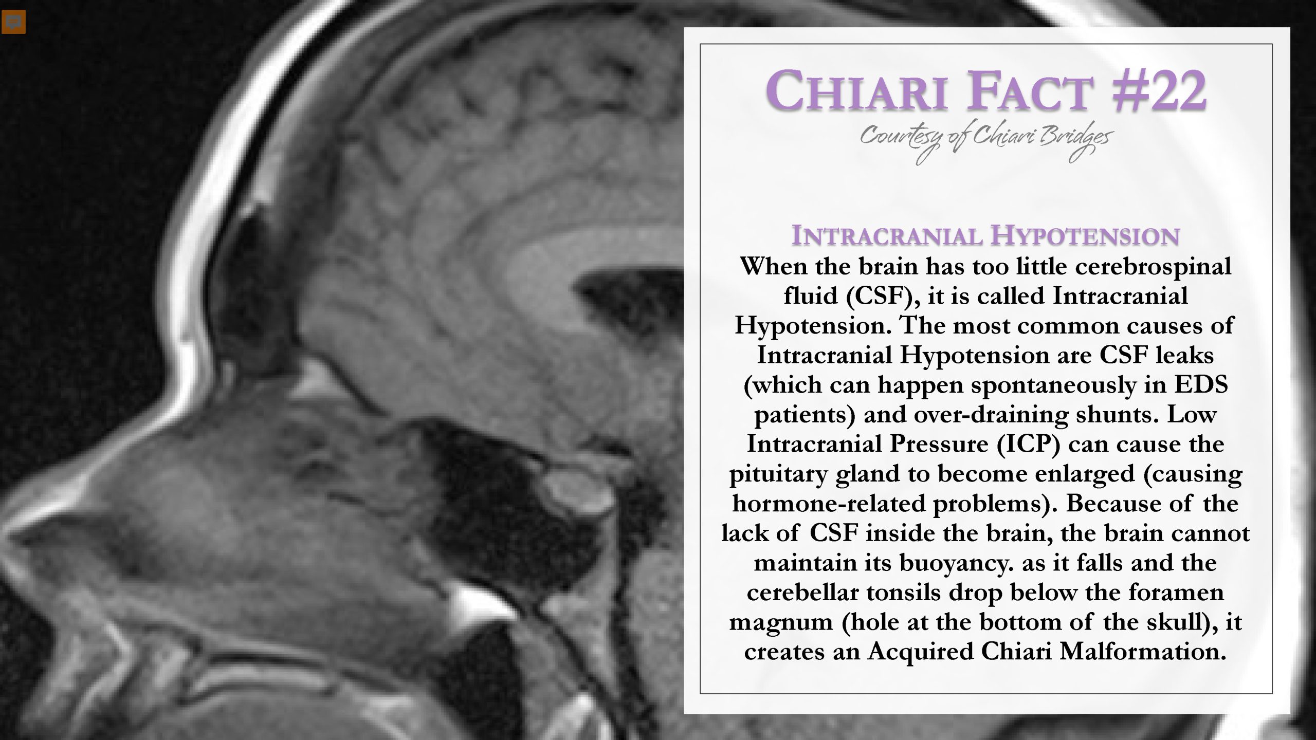 Chiari Fact #22