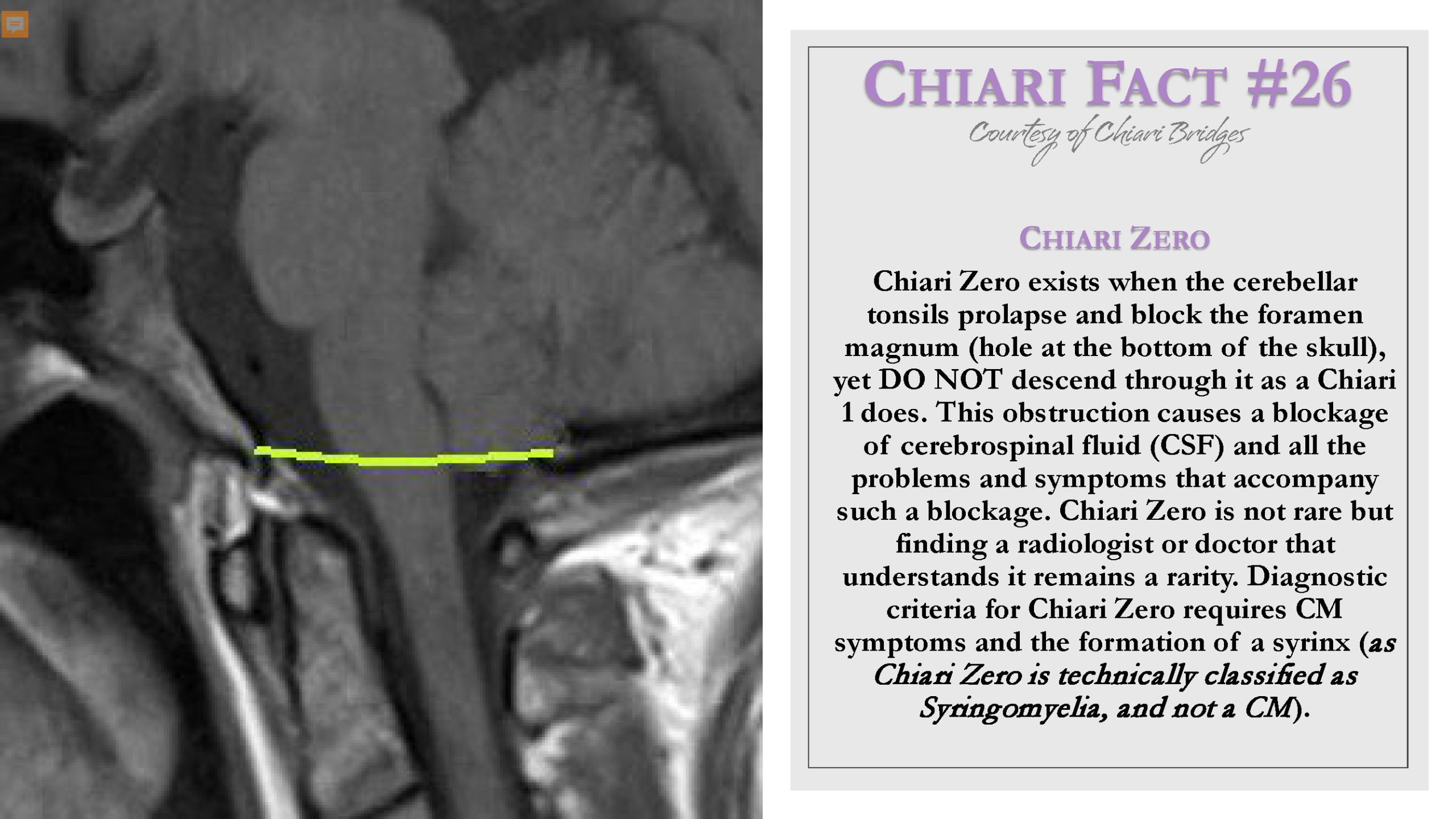 Chiari Fact #26