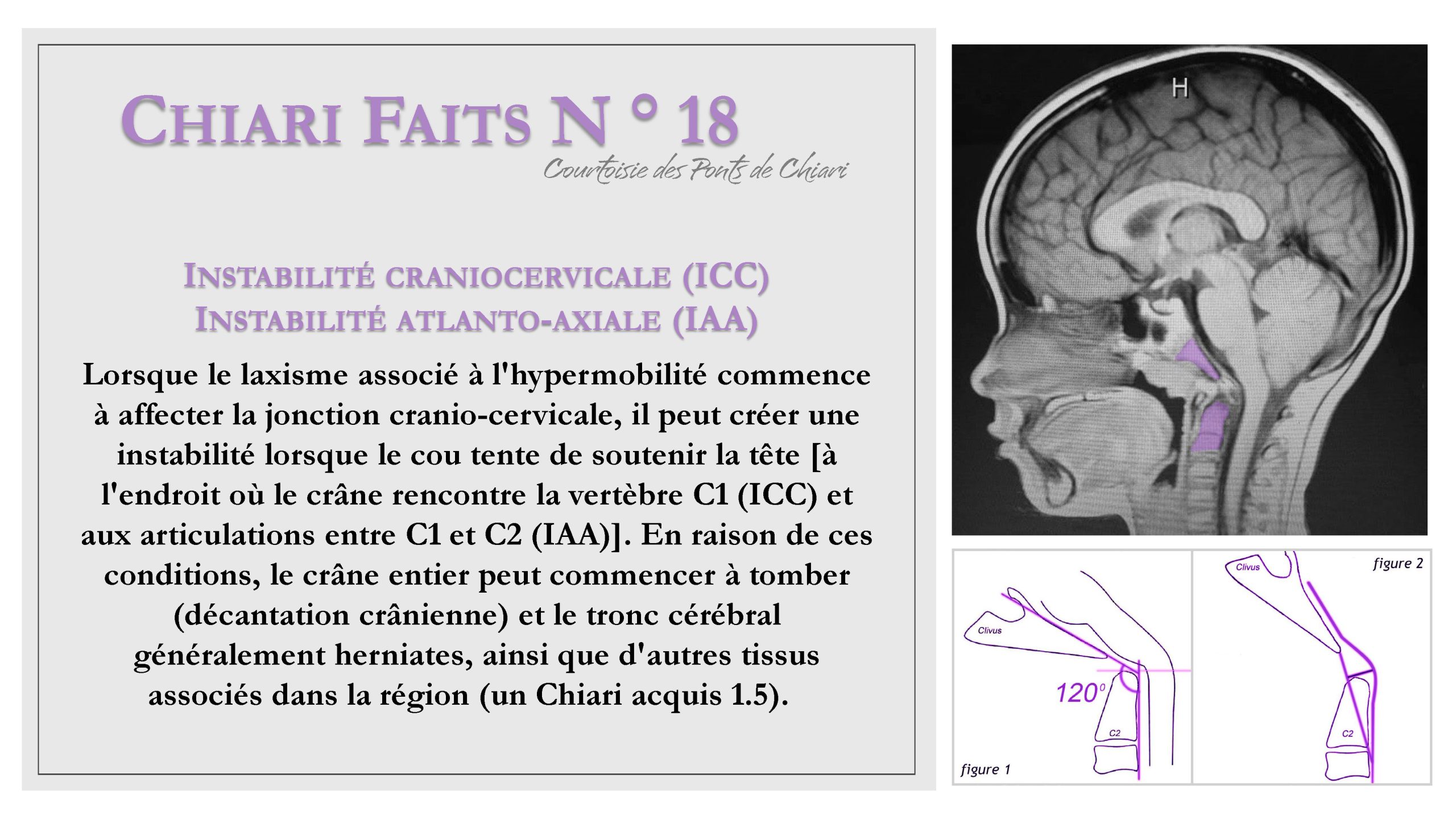 Chiari Faits N ° 18