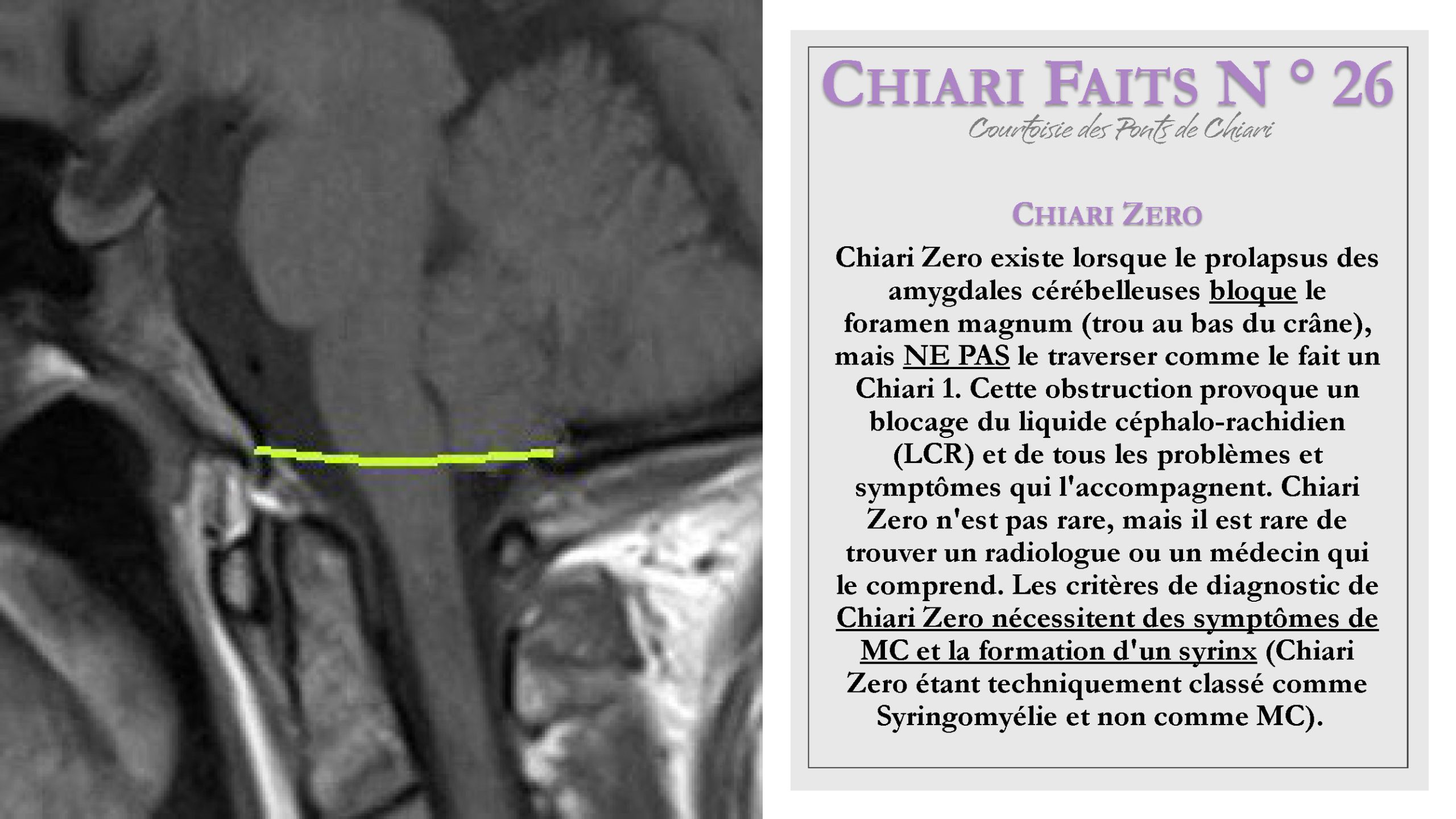 Chiari Faits N ° 26