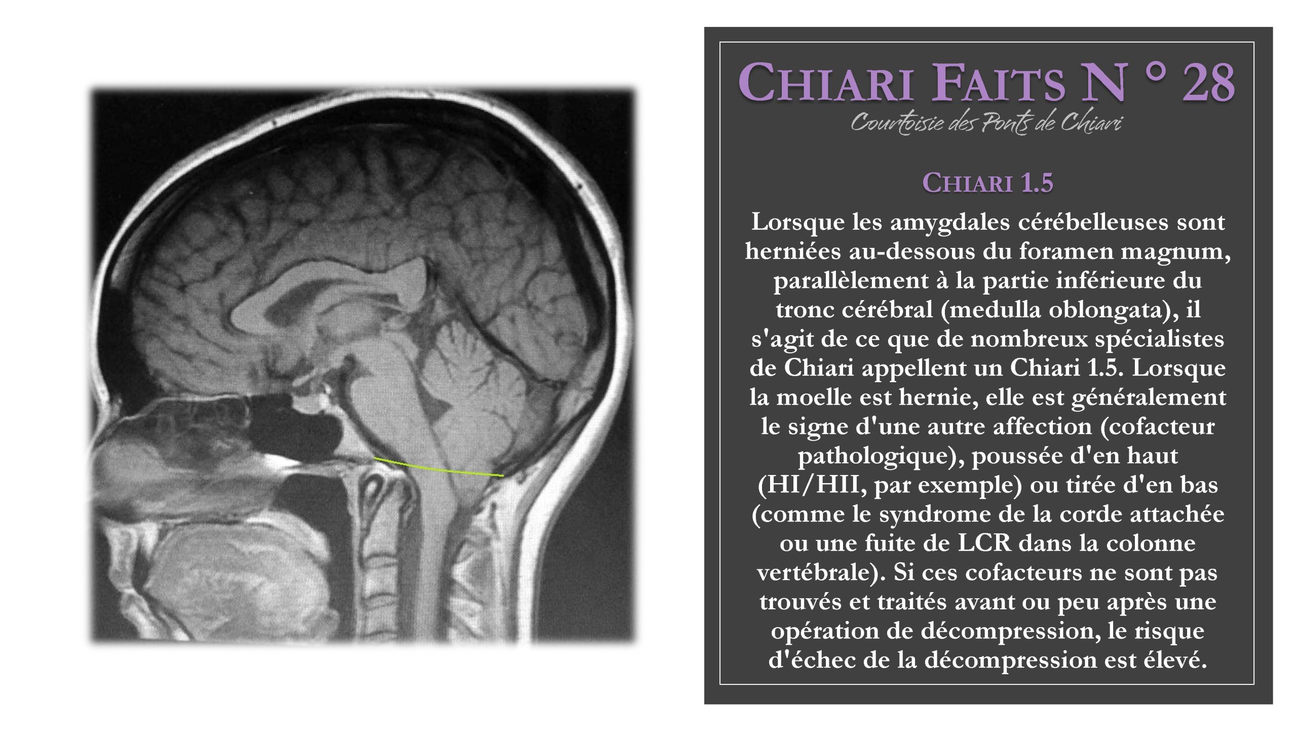 Chiari Faits N ° 28