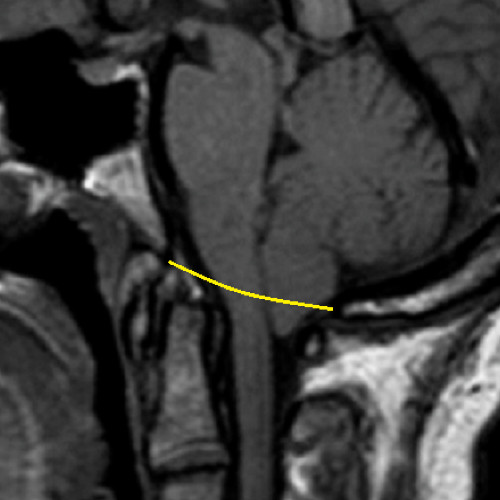 Chiari 1 Malformations, Explained