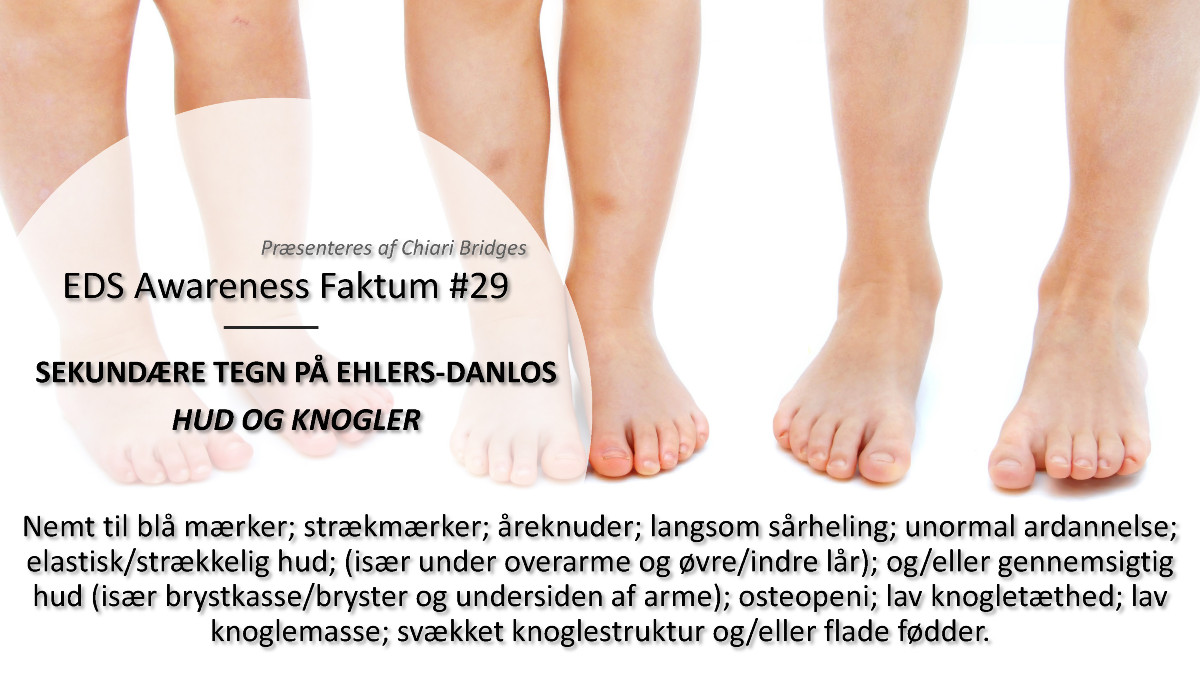 EDS Awareness Faktum #29