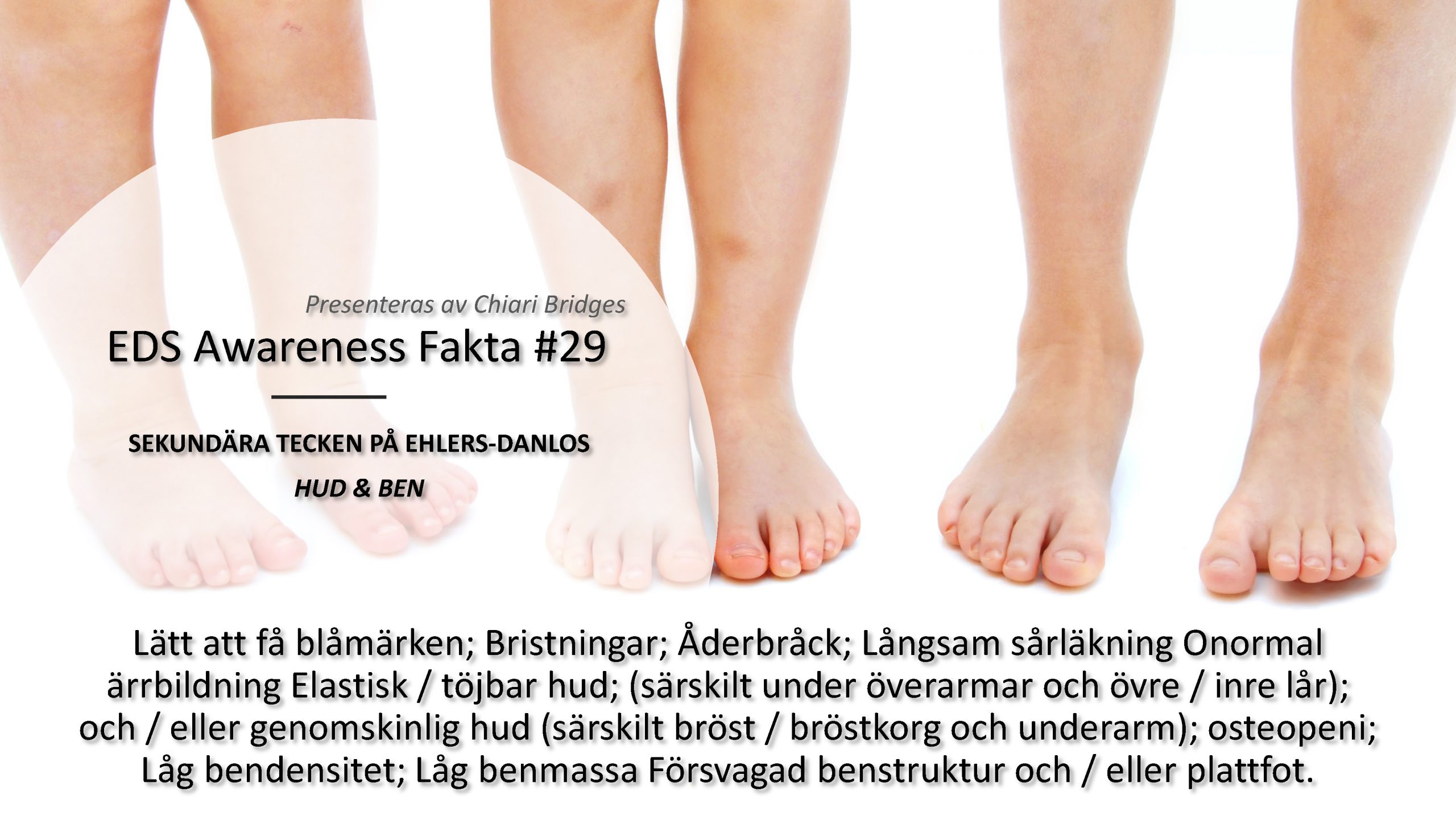 EDS Awareness Fakta #29